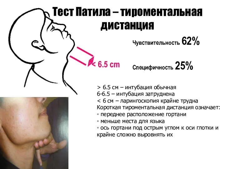 Тест Патила – тироментальная дистанция Чувствительность 62% Специфичность 25% >