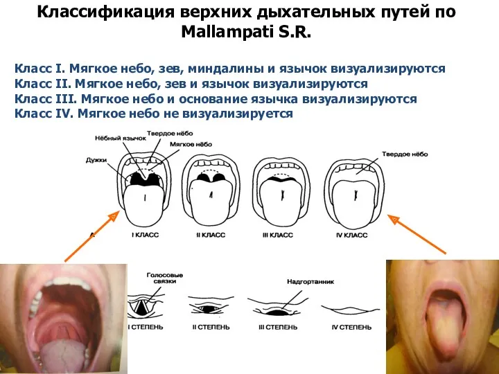 Классификация верхних дыхательных путей по Mallampati S.R. Класс I. Мягкое