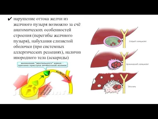 нарушение оттока желчи из желчного пузыря возможно за счёт анатомических