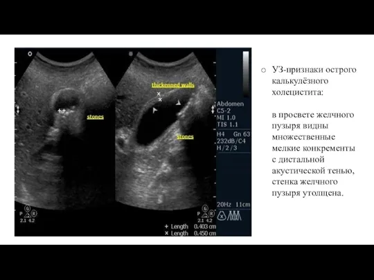 УЗ-признаки острого калькулёзного холецистита: в просвете желчного пузыря видны множественные