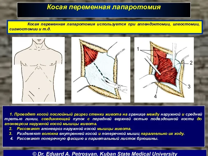 Косая переменная лапаротомия 1. Проводят косой послойный разрез стенки живота