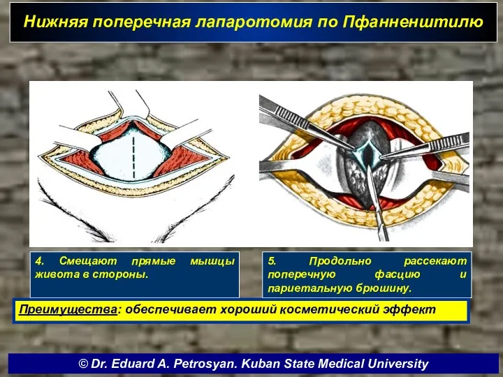 Нижняя поперечная лапаротомия по Пфанненштилю 4. Смещают прямые мышцы живота