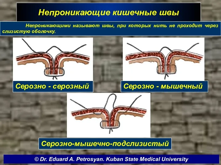 Непроникающие кишечные швы Серозно - серозный Серозно - мышечный Серозно-мышечно-подслизистый © Dr. Eduard