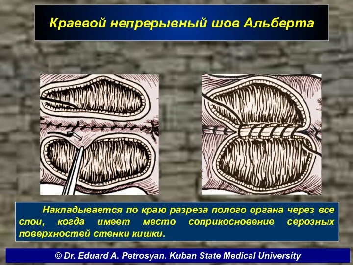 Краевой непрерывный шов Альберта Накладывается по краю разреза полого органа через все слои,