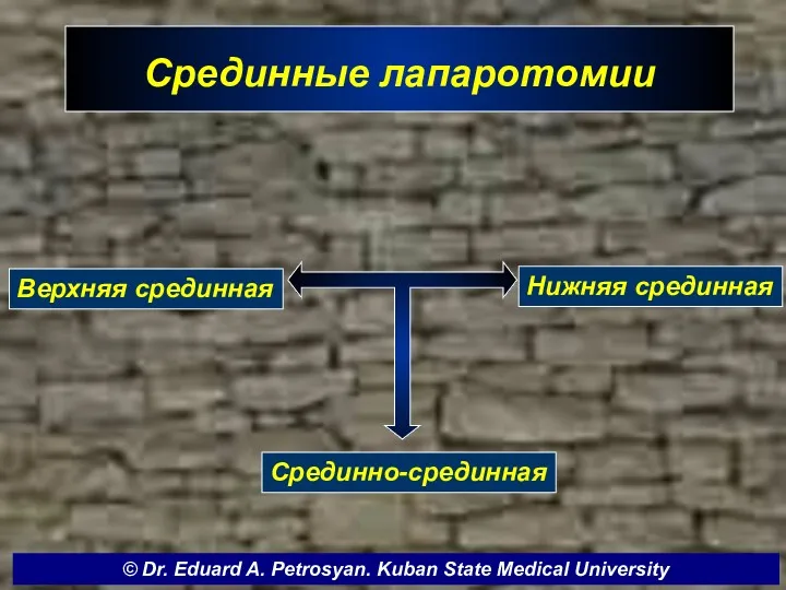 Срединные лапаротомии Верхняя срединная Нижняя срединная Срединно-срединная © Dr. Eduard A. Petrosyan. Kuban State Medical University