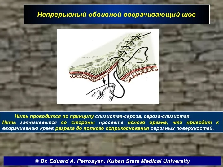 Непрерывный обвивной вворачивающий шов Нить проводится по принципу слизистая-сероза, сероза-слизистая. Нить затягивается со