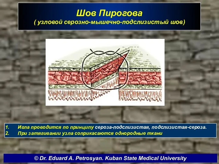 Шов Пирогова ( узловой серозно-мышечно-подслизистый шов) Игла проводится по принципу сероза-подслизистая, подслизистая-сероза. При