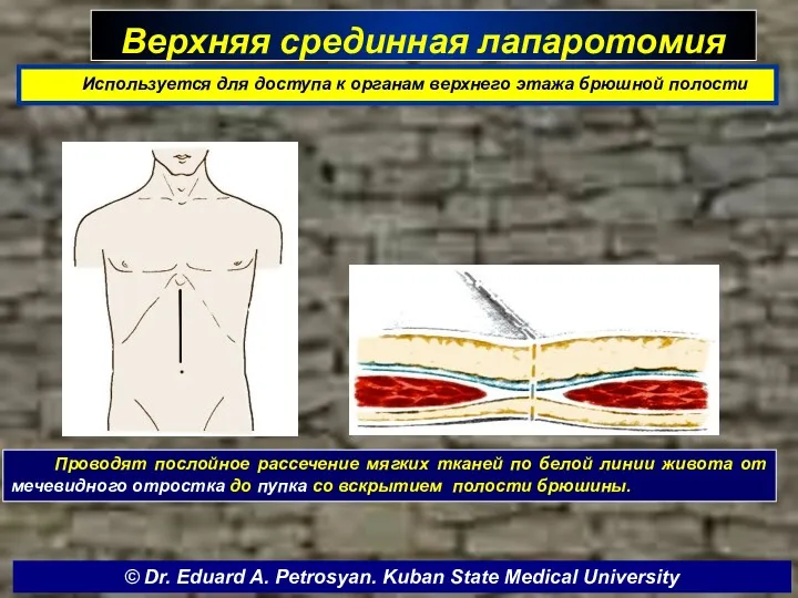 Верхняя срединная лапаротомия Используется для доступа к органам верхнего этажа брюшной полости Проводят