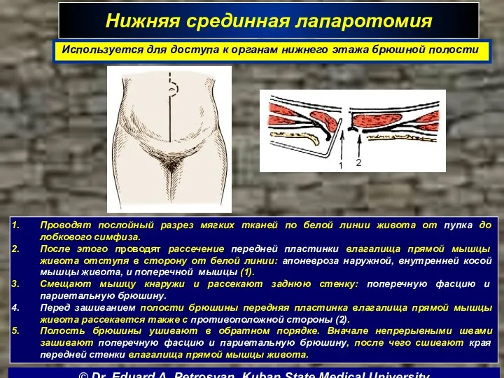 Нижняя срединная лапаротомия Используется для доступа к органам нижнего этажа брюшной полости Проводят