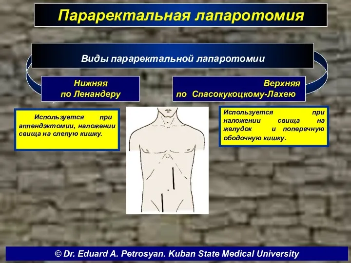 Виды параректальной лапаротомии Верхняя по Спасокукоцкому-Лахею Нижняя по Ленандеру Используется при аппендэктомии, наложении