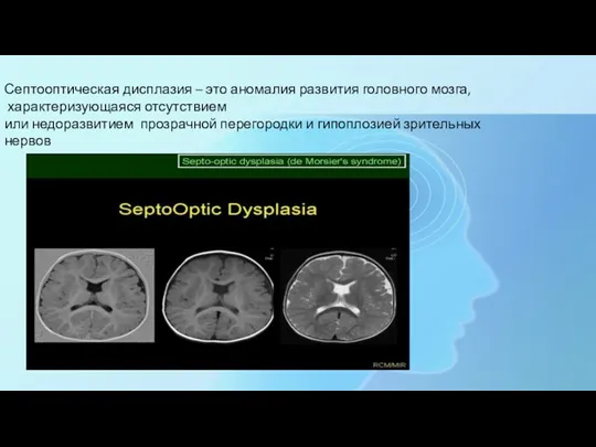 Септооптическая дисплазия – это аномалия развития головного мозга, характеризующаяся отсутствием
