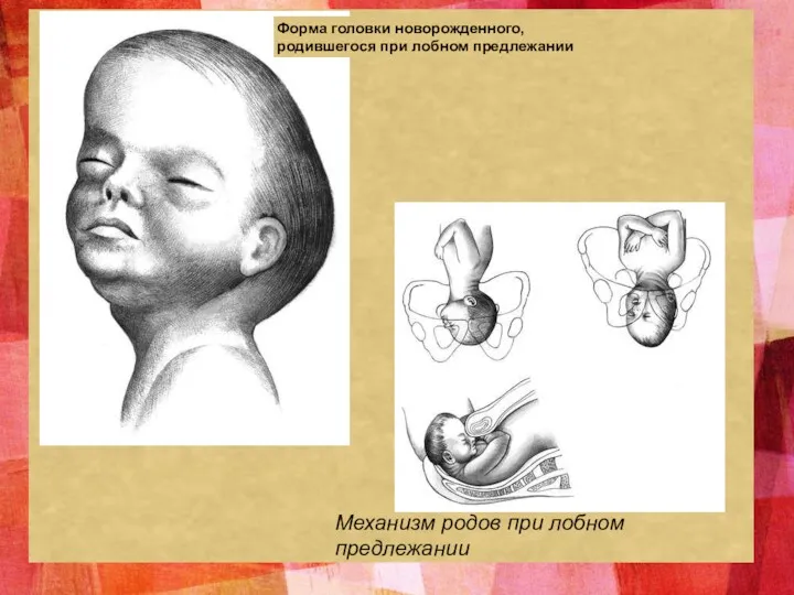 Форма головки новорожденного, родившегося при лобном предлежании Механизм родов при лобном предлежании