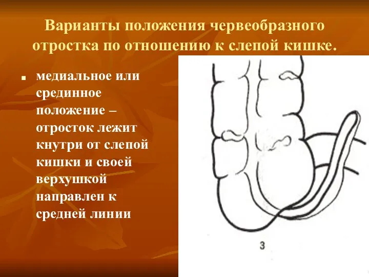 Варианты положения червеобразного отростка по отношению к слепой кишке. медиальное