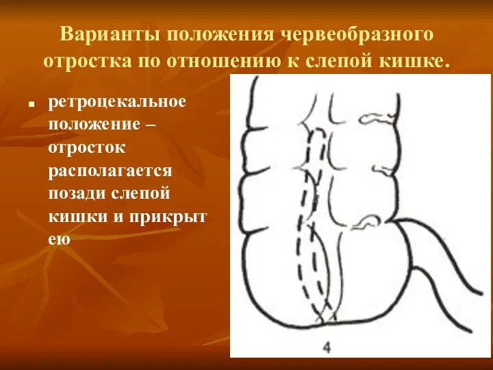 Варианты положения червеобразного отростка по отношению к слепой кишке. ретроцекальное