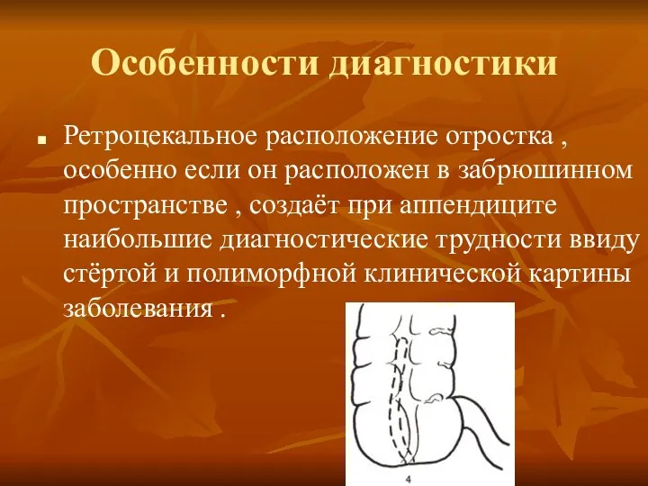 Особенности диагностики Ретроцекальное расположение отростка , особенно если он расположен