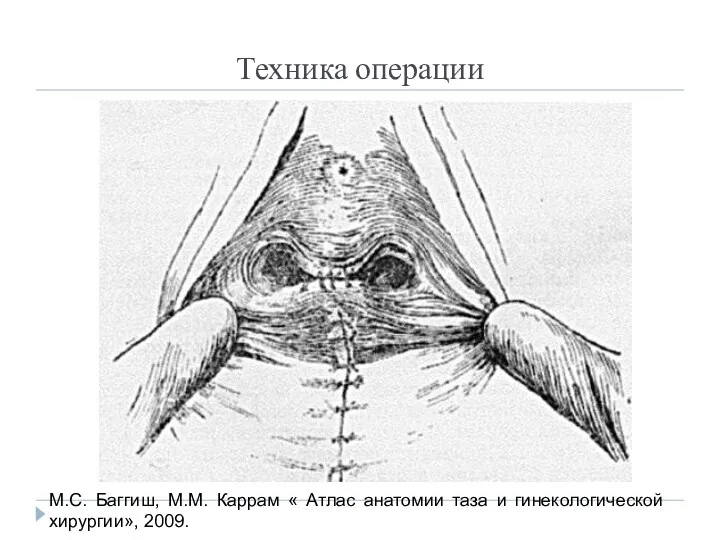 Техника операции М.С. Баггиш, М.М. Каррам « Атлас анатомии таза и гинекологической хирургии», 2009.