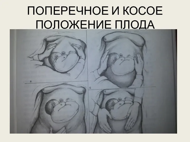 ПОПЕРЕЧНОЕ И КОСОЕ ПОЛОЖЕНИЕ ПЛОДА