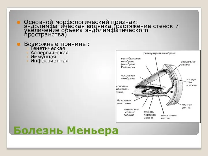 Болезнь Меньера Основной морфологический признак: эндолимфатическая водянка (растяжение стенок и