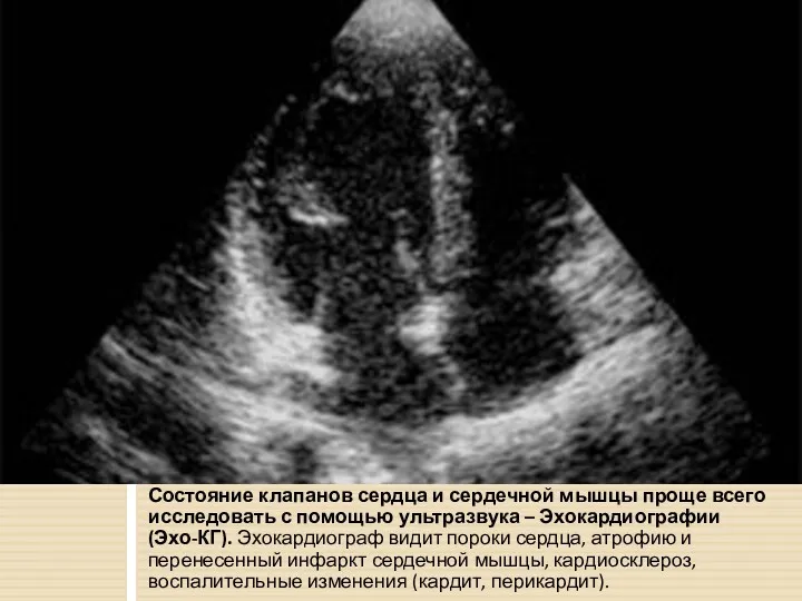 Состояние клапанов сердца и сердечной мышцы проще всего исследовать с