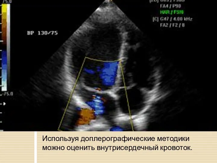 Используя доплерографические методики можно оценить внутрисердечный кровоток.