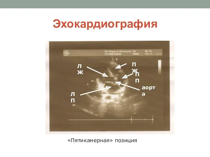 Эхокардиография «Пятикамерная» позиция ЛЖ ЛП ПЖ ПП аорта