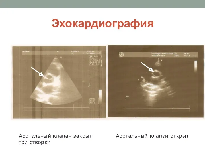 Эхокардиография Аортальный клапан закрыт: три створки Аортальный клапан открыт