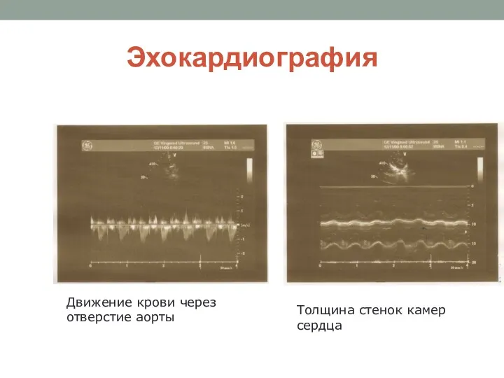 Эхокардиография Движение крови через отверстие аорты Толщина стенок камер сердца