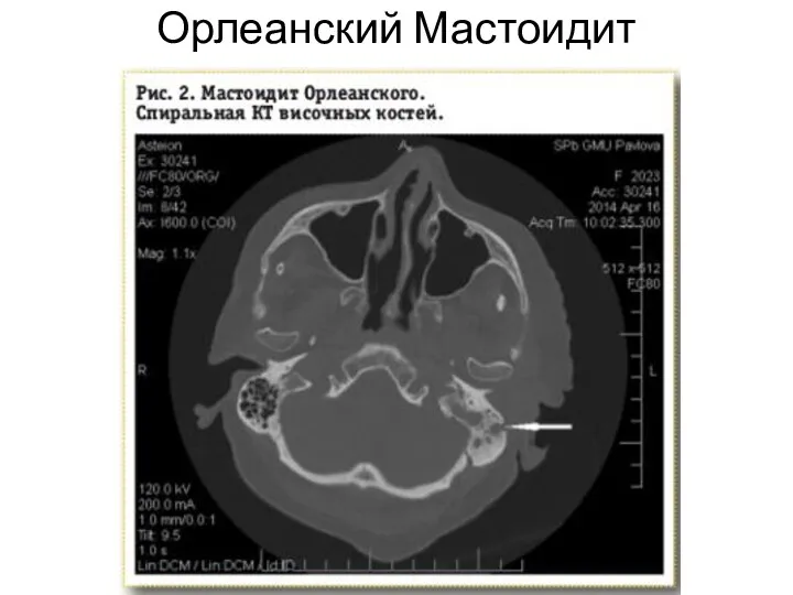 Орлеанский Мастоидит