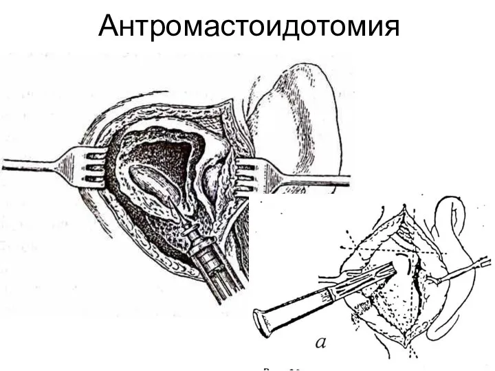 Антромастоидотомия