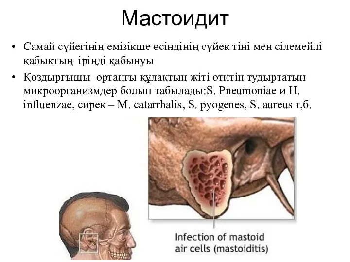 Мастоидит Самай сүйегінің емізікше өсіндінің сүйек тіні мен сілемейлі қабықтың