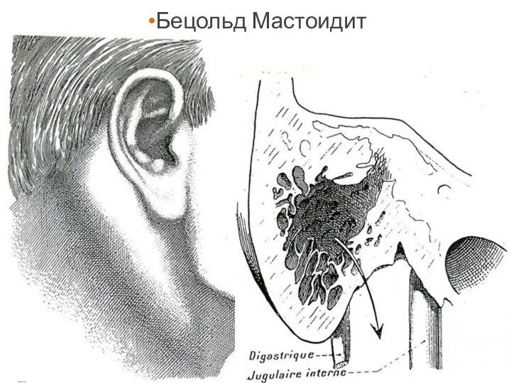 Бецольд Мастоидит