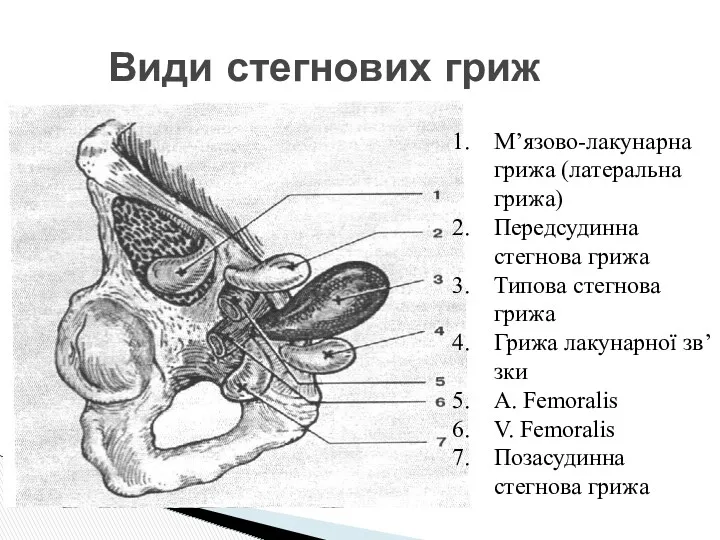 Види стегнових гриж М’язово-лакунарна грижа (латеральна грижа) Передсудинна стегнова грижа