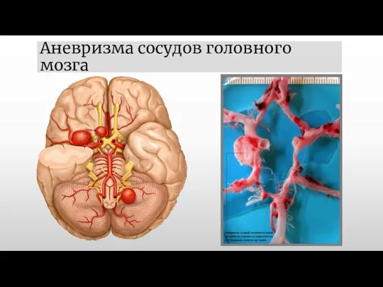 Аневризма сосудов головного мозга