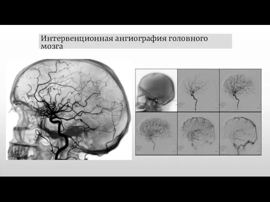 Интервенционная ангиография головного мозга