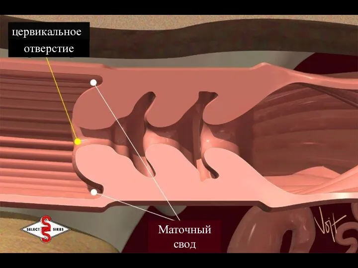 цервикальное отверстие Маточный свод