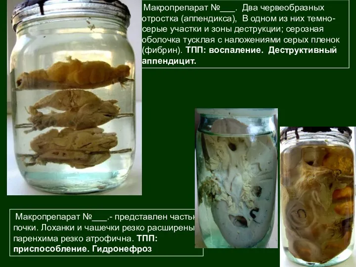 Макропрепарат №___.- представлен частью почки. Лоханки и чашечки резко расширены