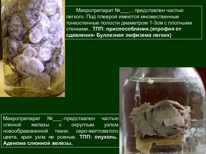 Макропрепарат №___.-представлен частью слюной железы с округлым узлом новообразованной ткани.