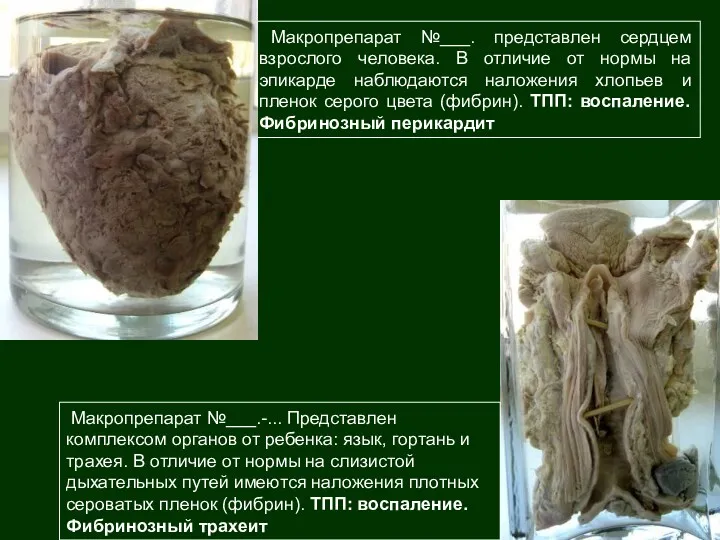 Макропрепарат №___. представлен сердцем взрослого человека. В отличие от нормы