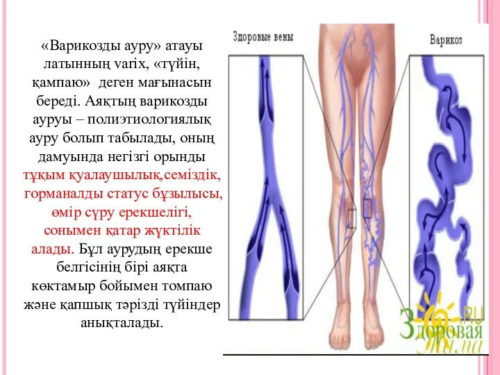 «Варикозды ауру» атауы латынның varix, «түйін, қампаю» деген мағынасын береді.