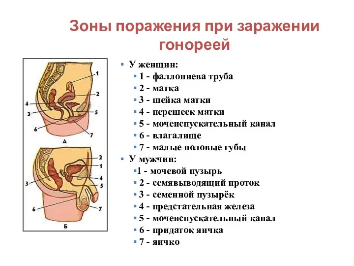 Зоны поражения при заражении гонореей У женщин: 1 - фаллопиева труба 2 -