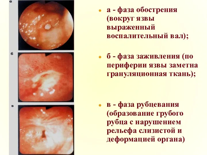 а - фаза обострения (вокруг язвы выраженный воспалительный вал); б
