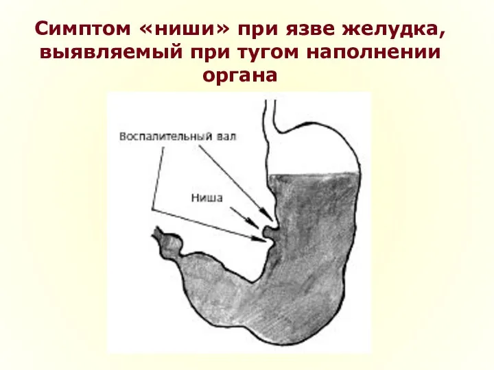 Симптом «ниши» при язве желудка, выявляемый при тугом наполнении органа