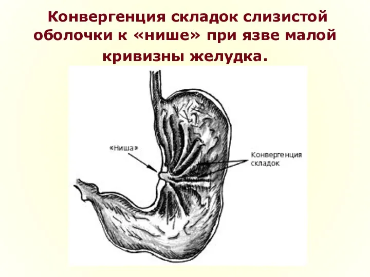 Конвергенция складок слизистой оболочки к «нише» при язве малой кривизны желудка.