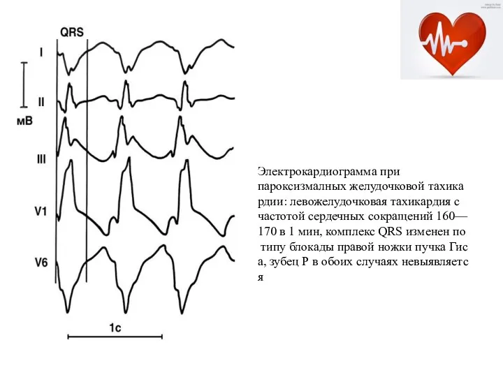 Электрокардиограмма при пароксизмалных желудочковой тахикардии: левожелудочковая тахикардия с частотой сердечных