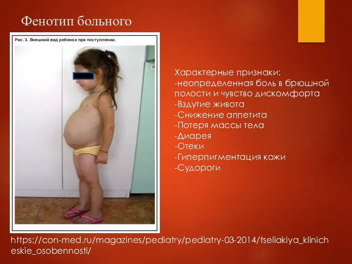 Фенотип больного https://con-med.ru/magazines/pediatry/pediatry-03-2014/tseliakiya_klinicheskie_osobennosti/ Характерные признаки: -неопределенная боль в брюшной полости