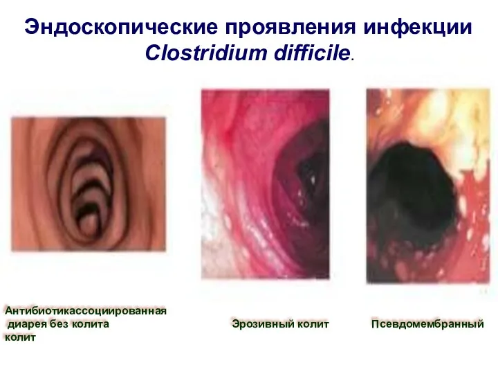 Антибиотикассоциированная диарея без колита Эрозивный колит Псевдомембранный колит Эндоскопические проявления инфекции Clostridium difficile.