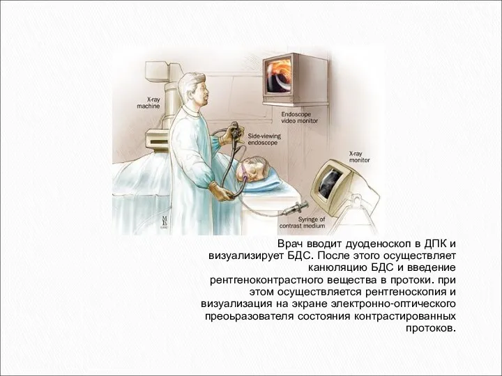 Врач вводит дуоденоскоп в ДПК и визуализирует БДС. После этого осуществляет канюляцию БДС