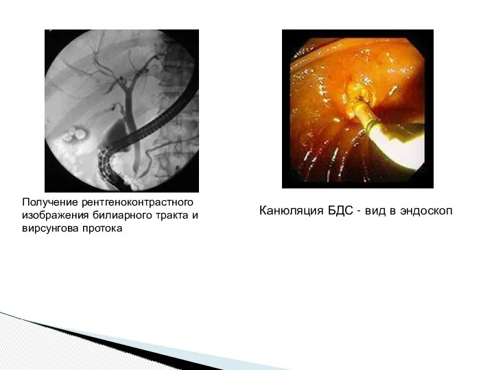 Получение рентгеноконтрастного изображения билиарного тракта и вирсунгова протока Канюляция БДС - вид в эндоскоп