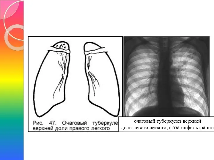 очаговый туберкулез верхней доли левого лёгкого, фаза инфильтрации
