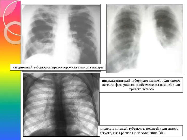 кавернозный туберкулез, правосторонняя эмпиема плевры инфильтративный туберкулез верхней доли левого легкого, фаза распада